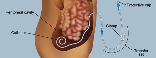 Benefits of Home Dialysis